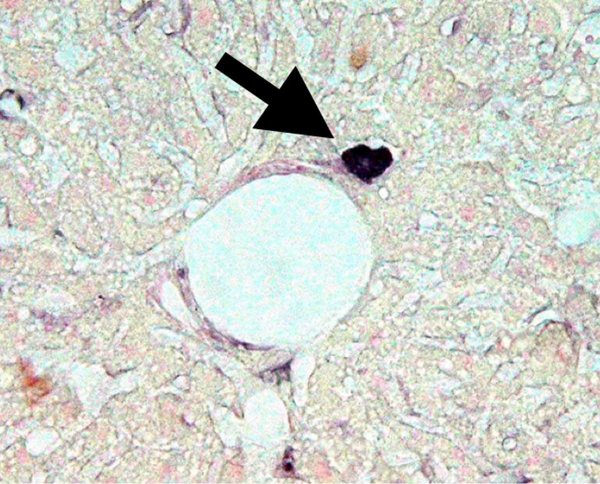 Diabetes Stem Cells