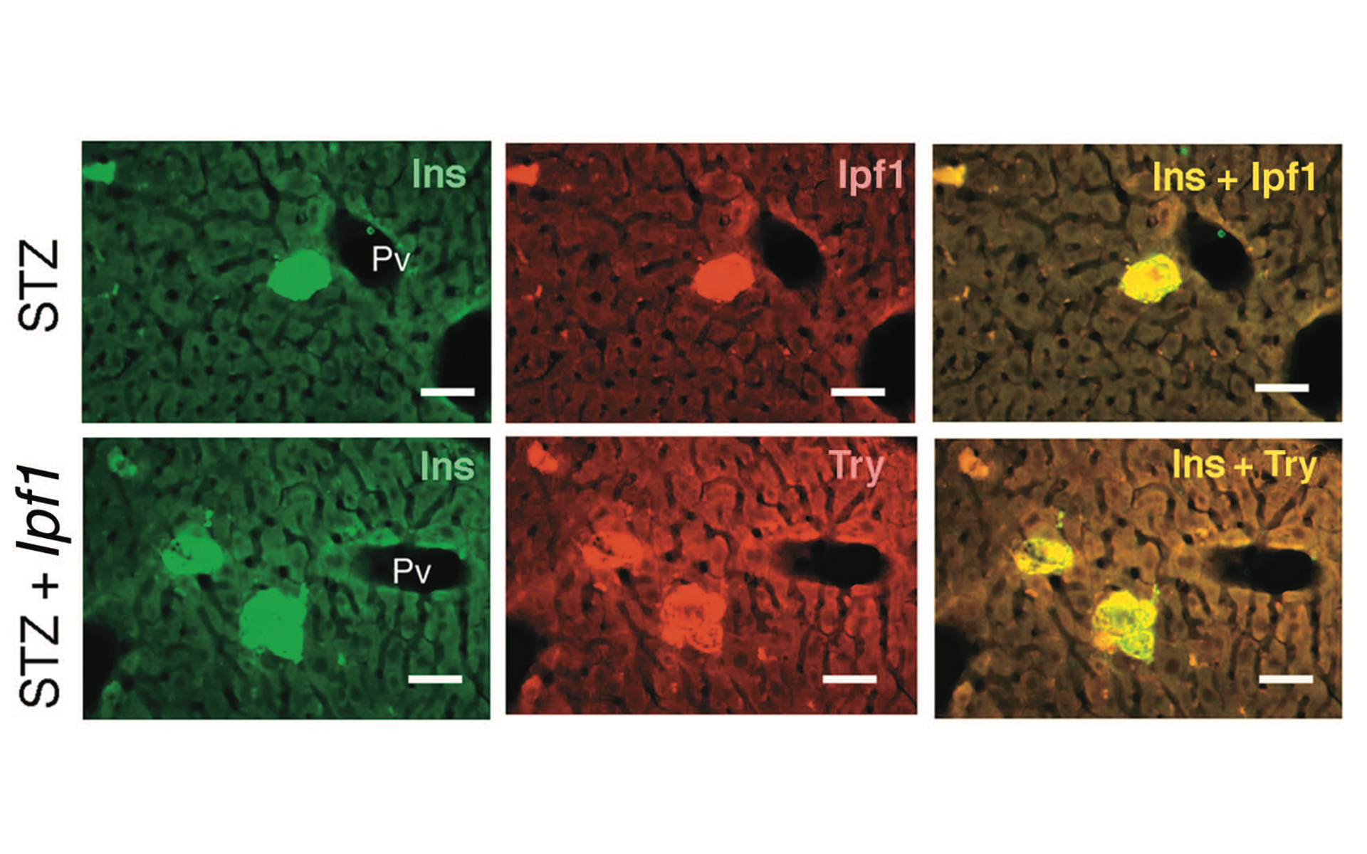 Strange Cells Producing Proinsulin Scattered in the Portal Triad